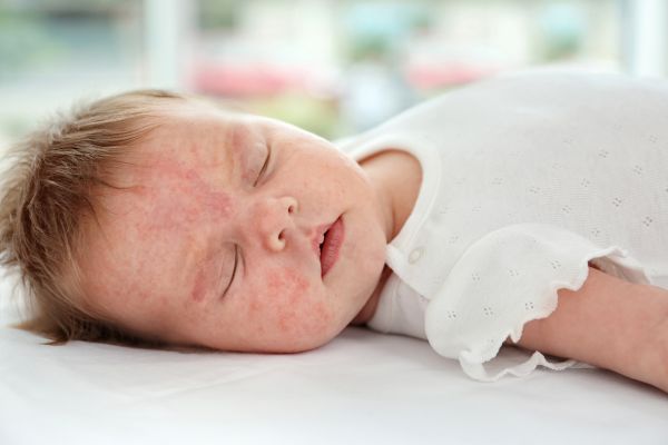 baby rash vs eczema